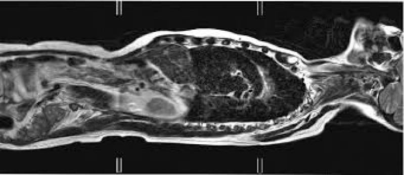 Quanto Custa Exame de Ressonância Magnética Engenheiro Coelho - Elastografia Hepática por Fibroscan