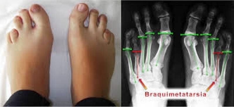 Quanto Custa Tratamento Braquidactilia em Valinhos - Clinica Especializada em Doenças Raras