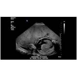 elastografias hepáticas por fibroscan Santo Antônio de Posse