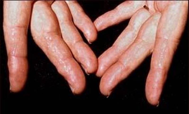 Tratamentos de Amiloidose em Limeira - Tratamento de Doenças Genéticas